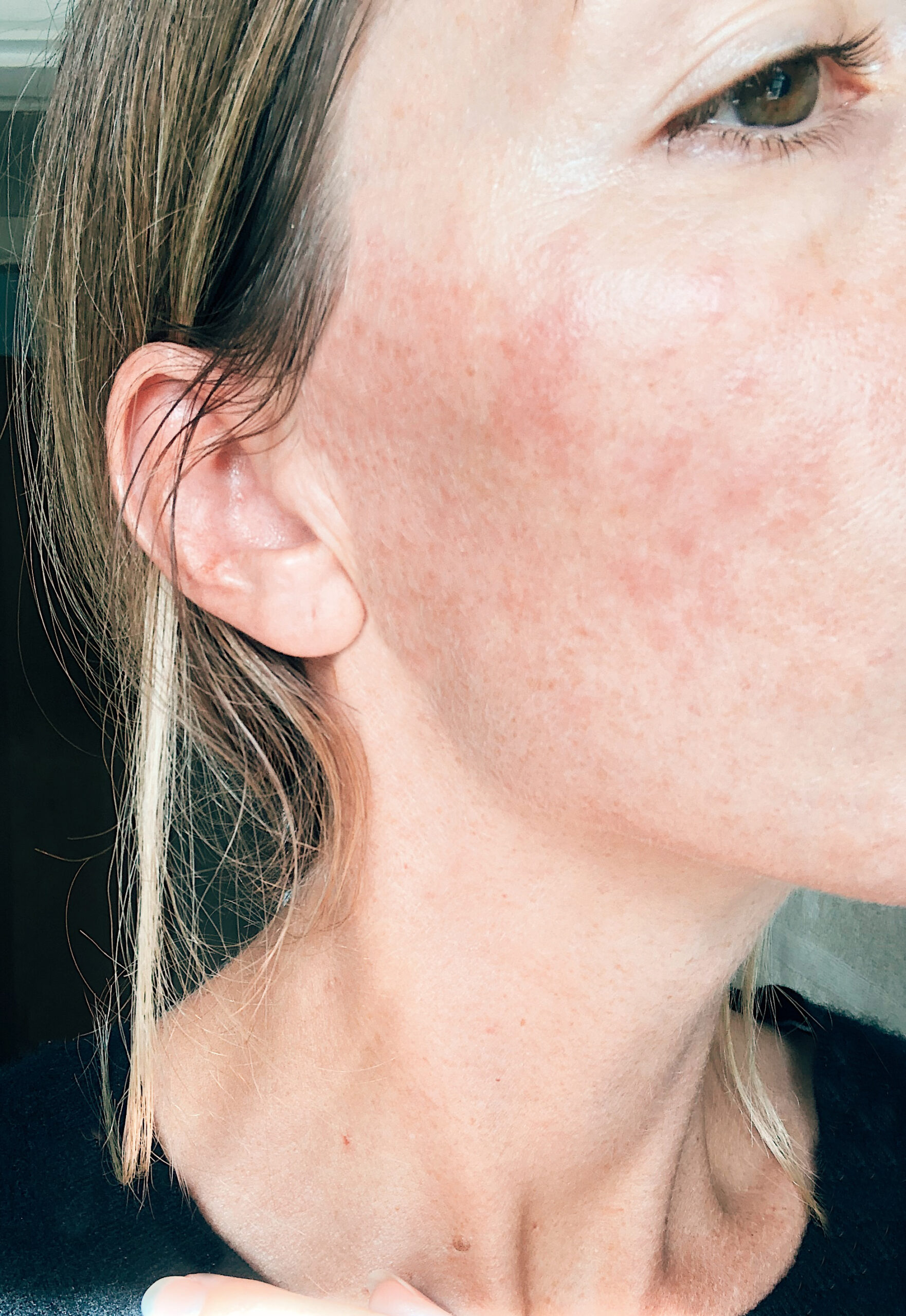Month 5: Red hot rash on my cheeks