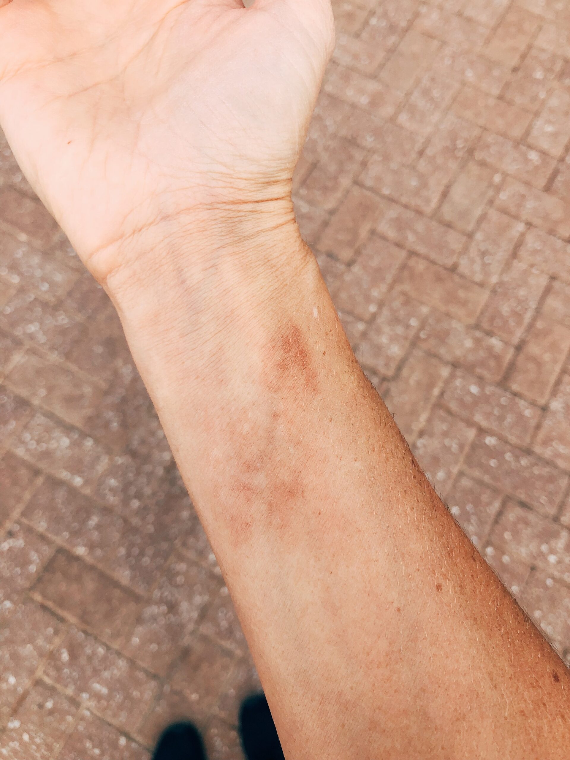 Month 5: Bruise like rash on my wrist